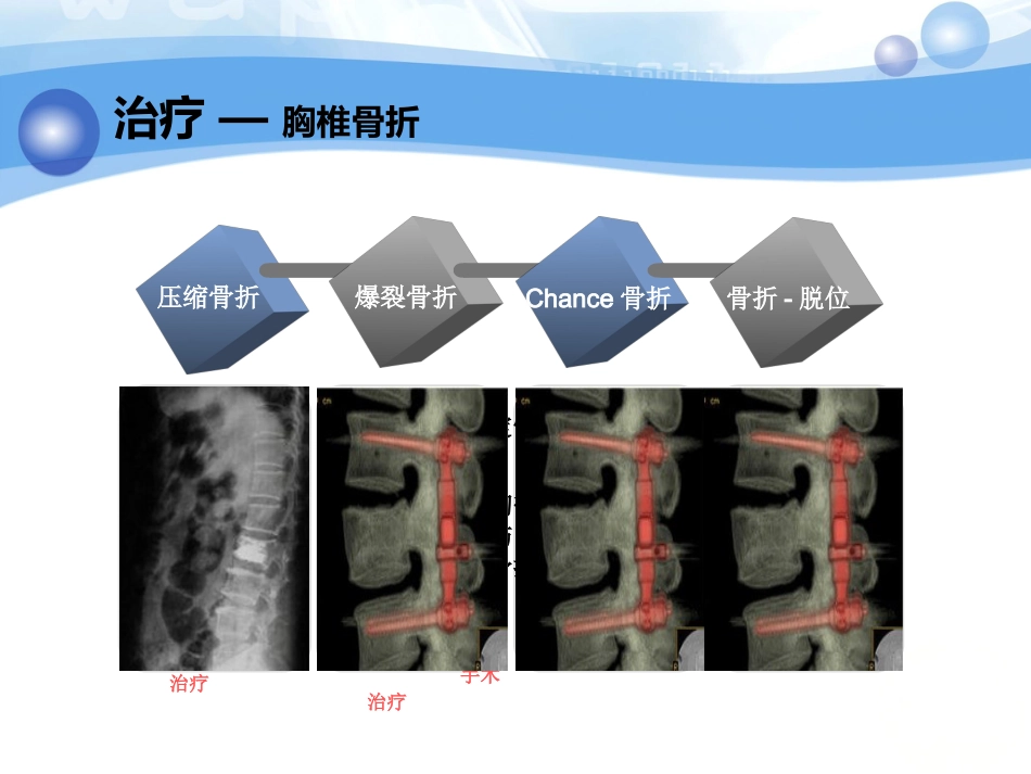 神经内科-脊柱脊髓损伤、骨盆骨折_第13页