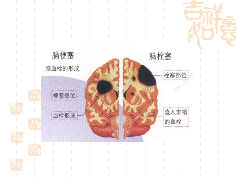 神经内科脑血栓_第11页