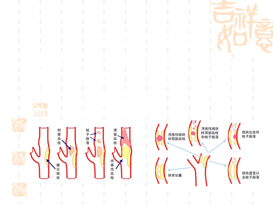 神经内科脑血栓_第6页