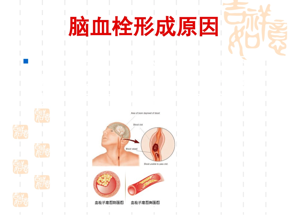神经内科脑血栓_第7页