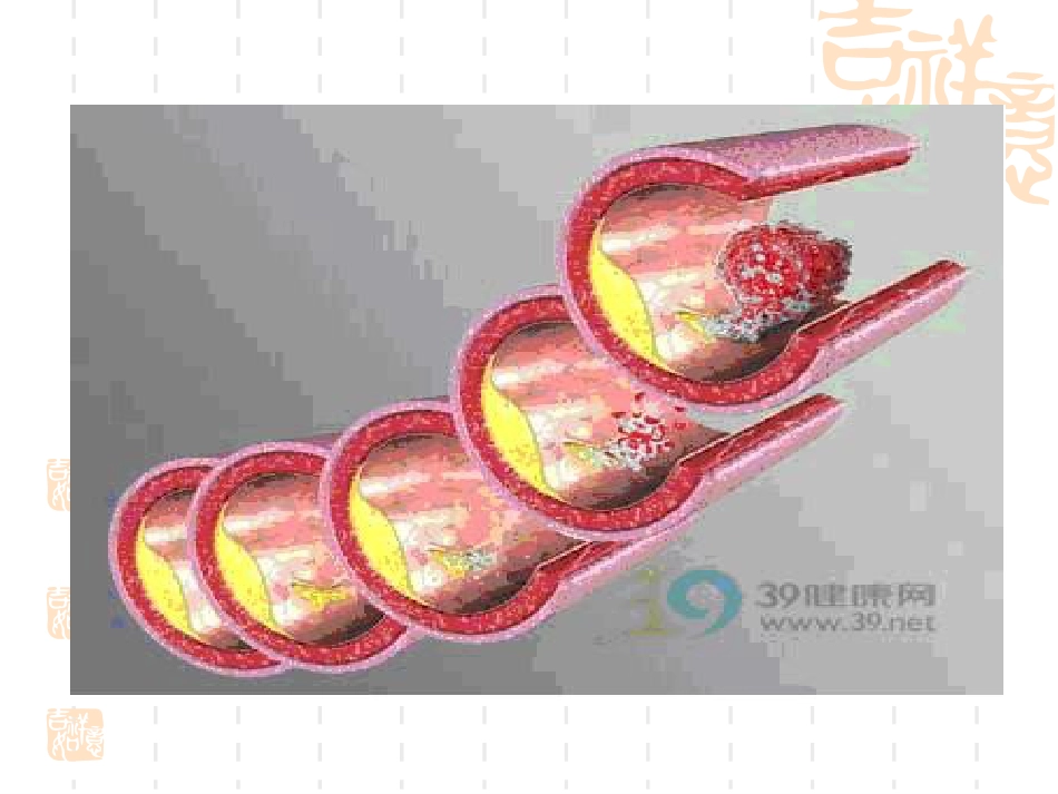 神经内科脑血栓_第9页