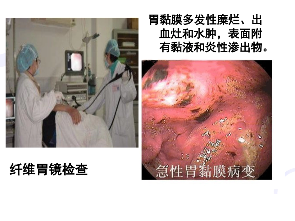 胃炎的护理_第11页