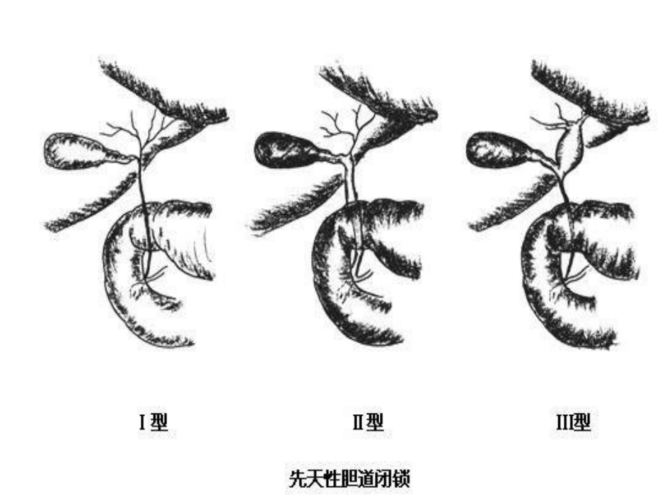 外科——胆道疾病_第15页