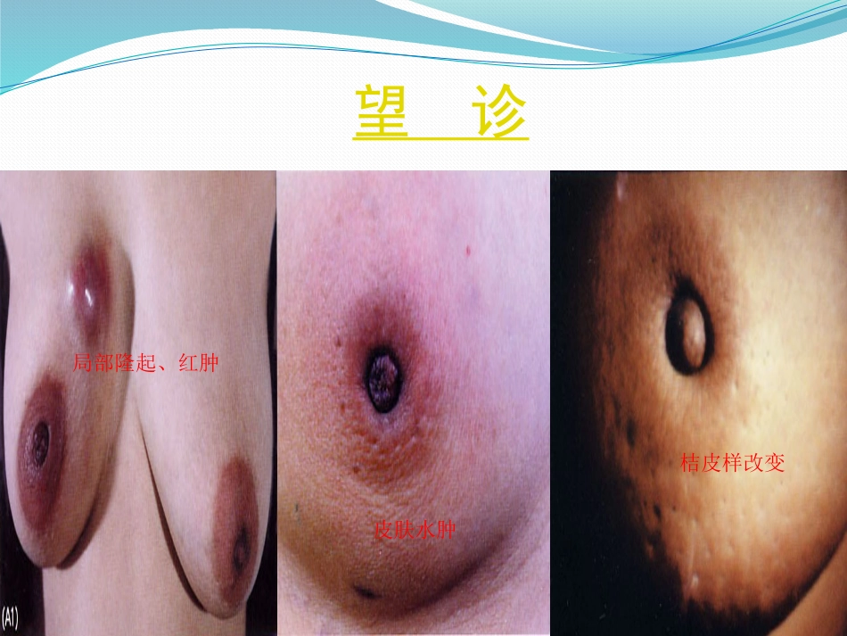 乳腺外科-乳腺_第14页