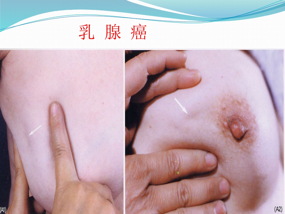 乳腺外科-乳腺_第15页