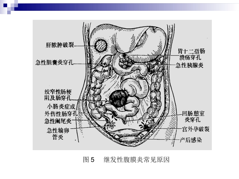 普外科-急性化脓性腹膜炎_第14页