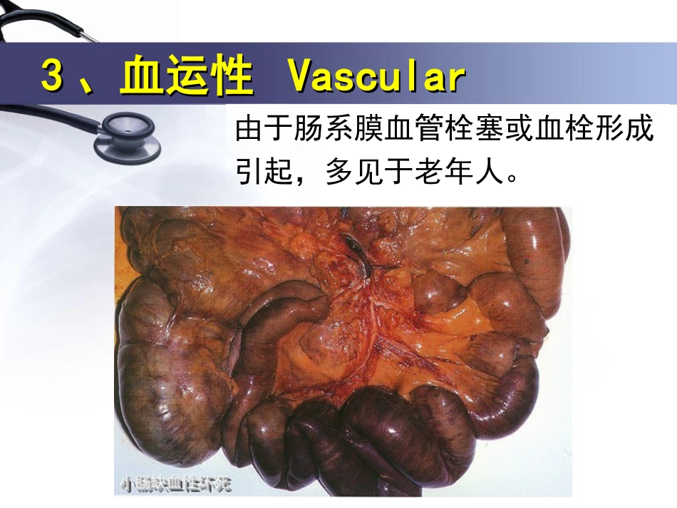 胃肠外科-肠梗阻_第7页