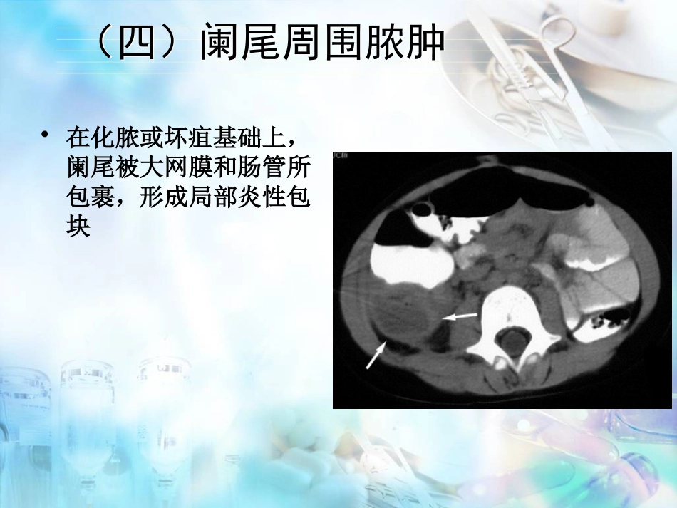 胃肠外科-阑尾炎、结直肠肛管疾病_第12页