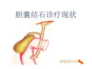 外科-胆囊结石及其防治