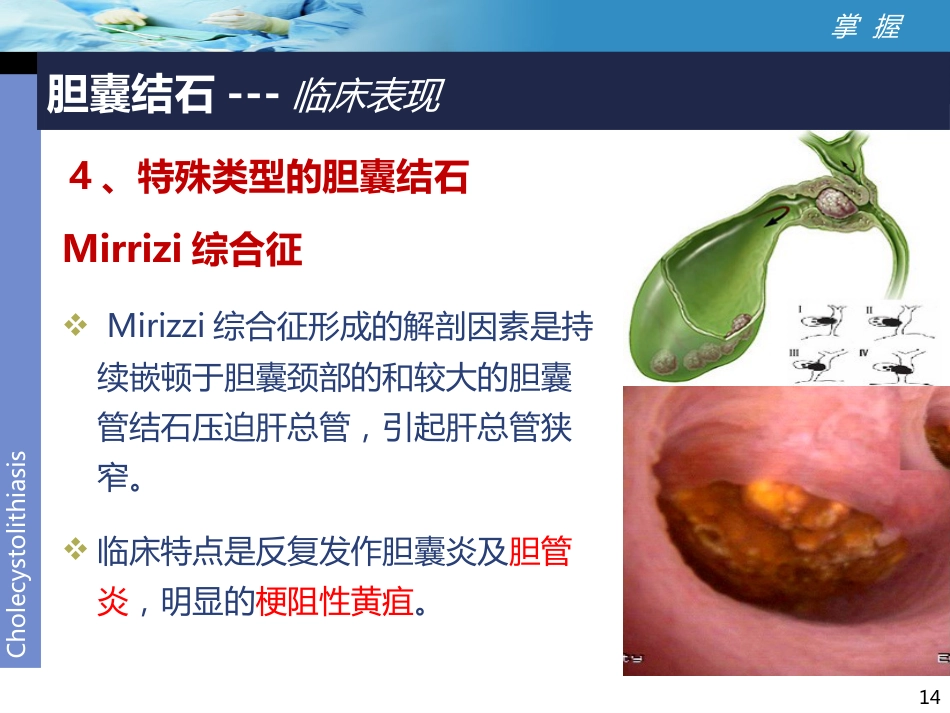 外科-胆囊结石讲课比赛_第14页