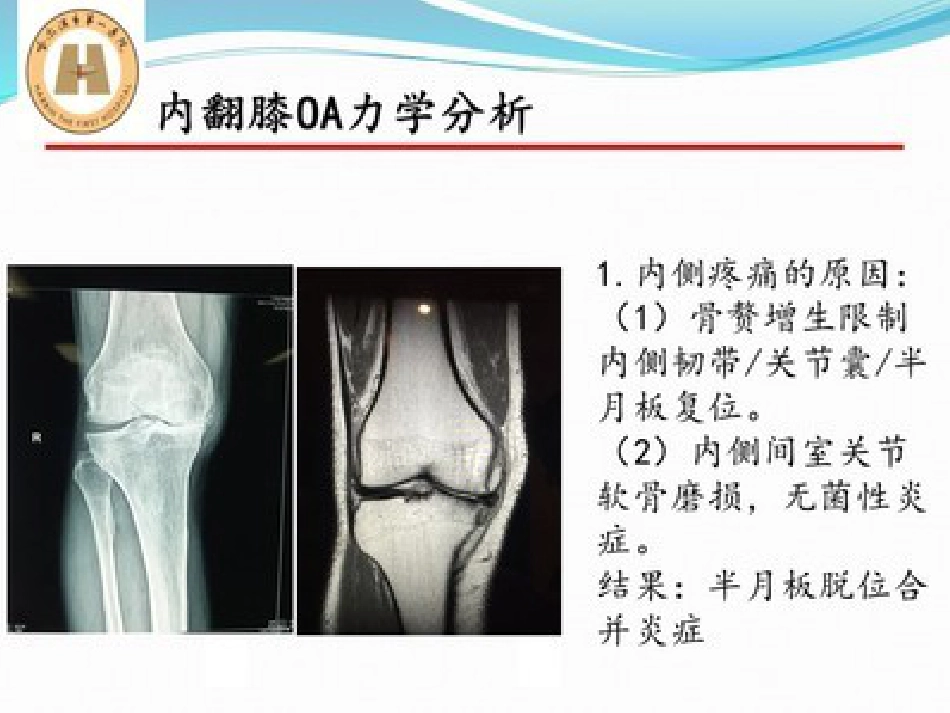 胫骨高位截骨治疗 膝关节骨性关节炎_第14页