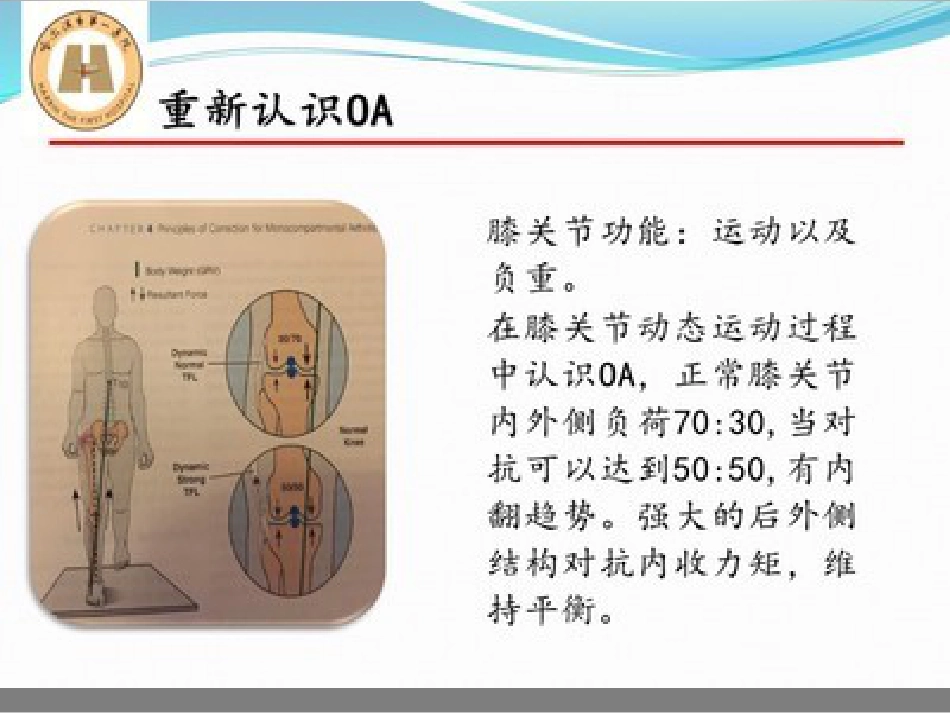 胫骨高位截骨治疗 膝关节骨性关节炎_第4页