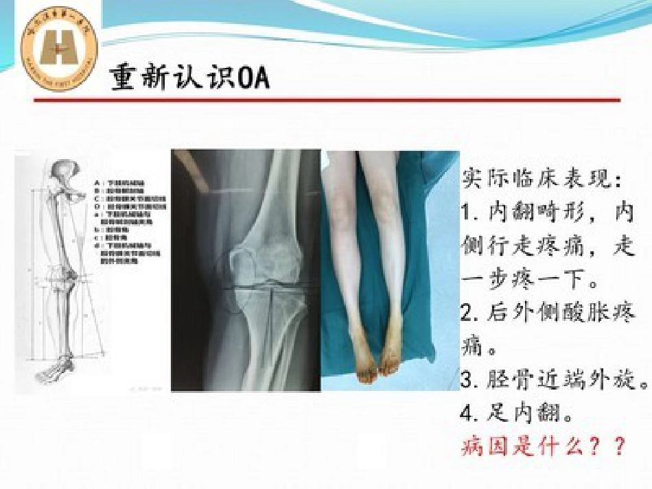 胫骨高位截骨治疗 膝关节骨性关节炎_第8页