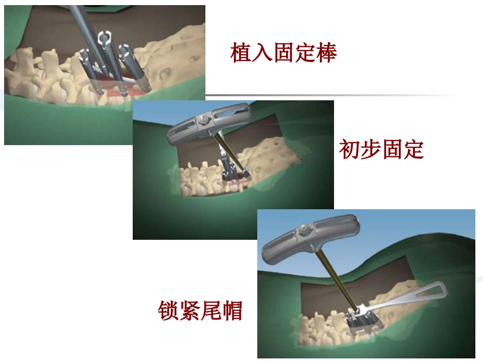 经皮椎弓根螺钉内固定 术治疗胸腰椎骨折固定_第14页