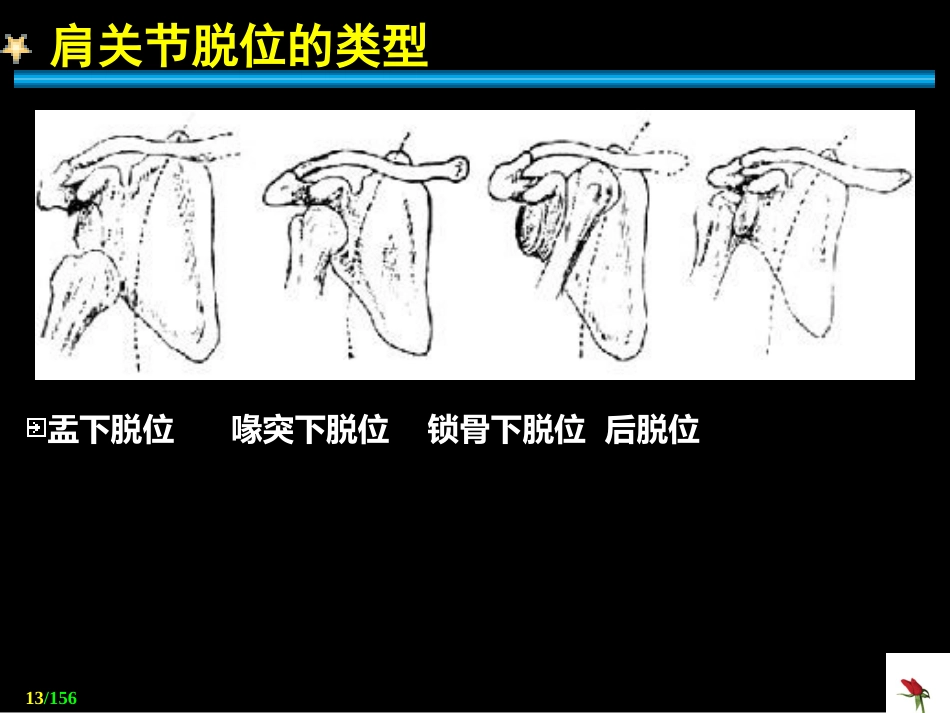 关节 脱位_第13页