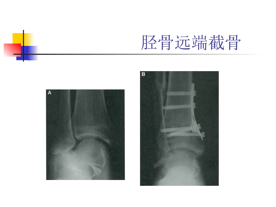 踝关节骨性关 节炎_第11页