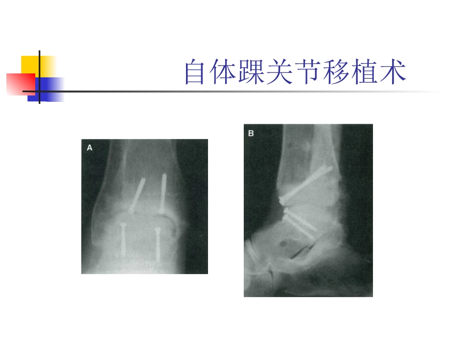 踝关节骨性关 节炎_第12页