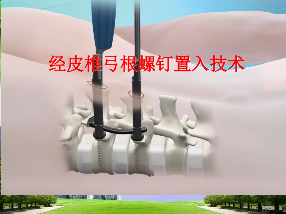 经皮椎弓根 钉置入技术_第1页