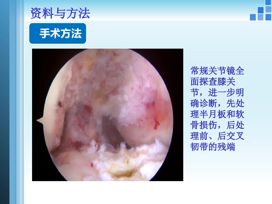 关节镜膝关节 多发韧带损伤的修复_第12页