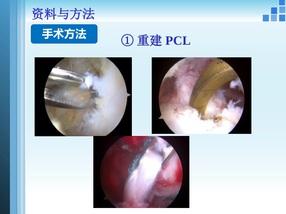 关节镜膝关节 多发韧带损伤的修复_第14页