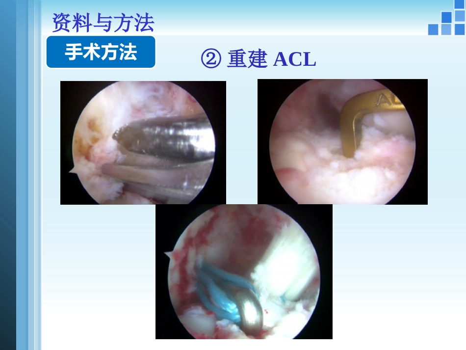 关节镜膝关节 多发韧带损伤的修复_第15页