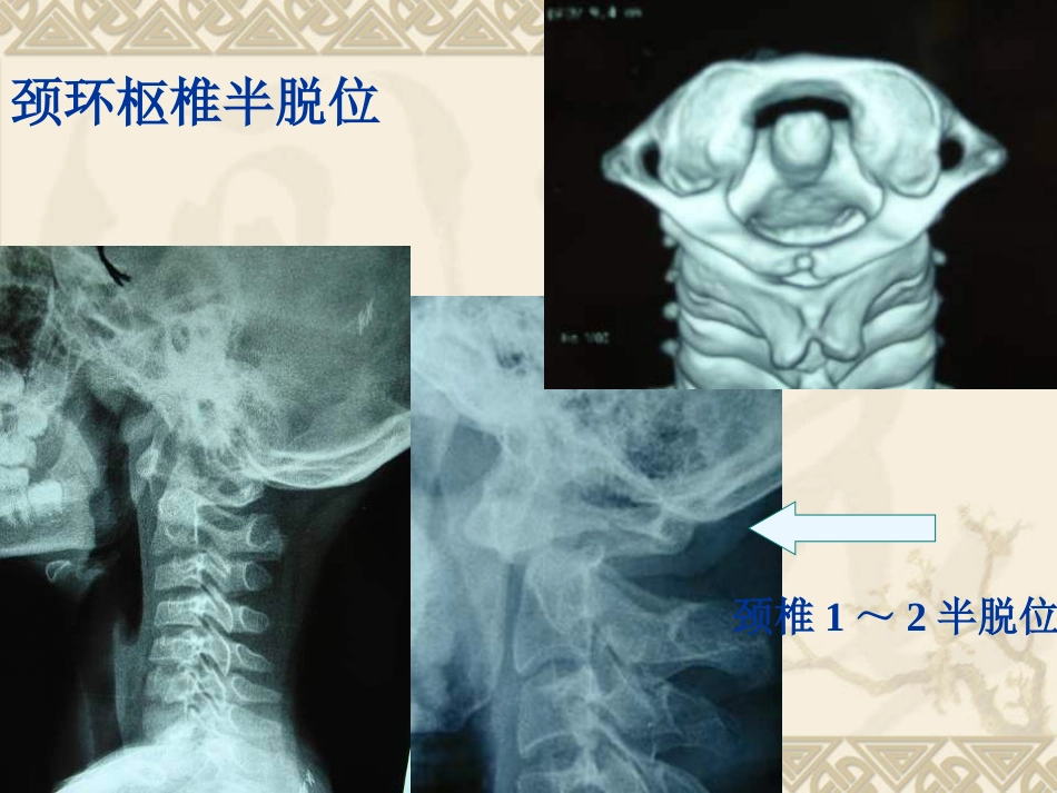 颈椎骨 折_第12页