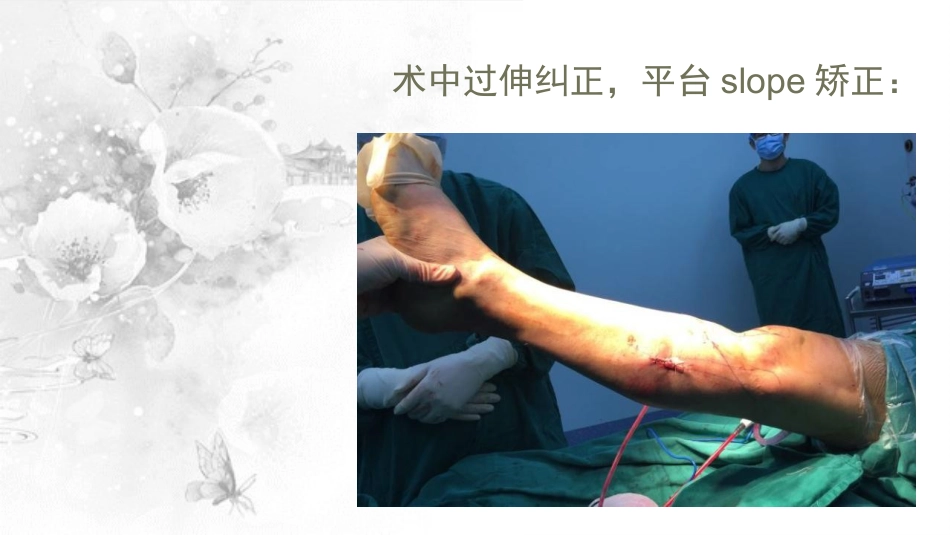 截骨术在不稳定 膝关节的作用_第13页