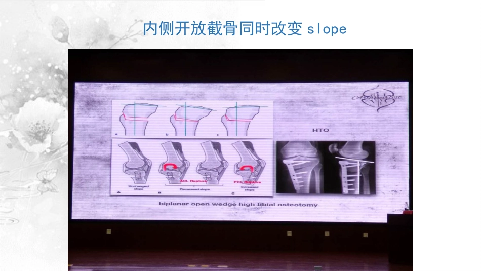截骨术在不稳定 膝关节的作用_第15页