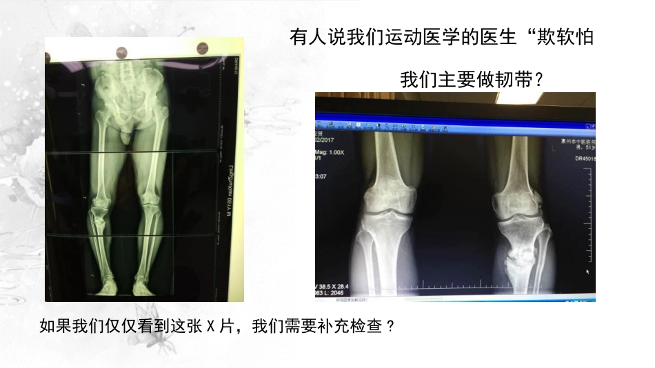 截骨术在不稳定 膝关节的作用_第2页