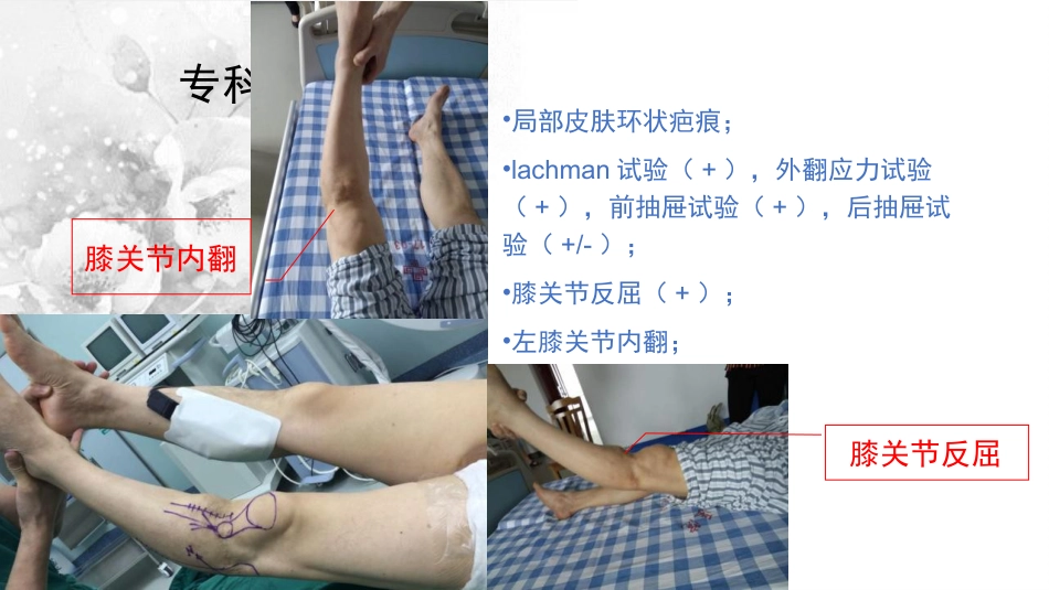 截骨术在不稳定 膝关节的作用_第5页