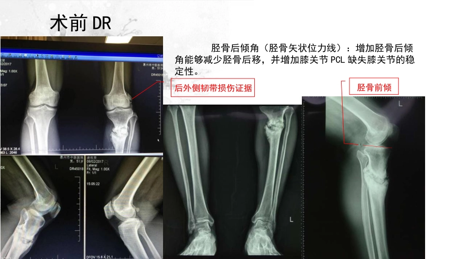 截骨术在不稳定 膝关节的作用_第7页
