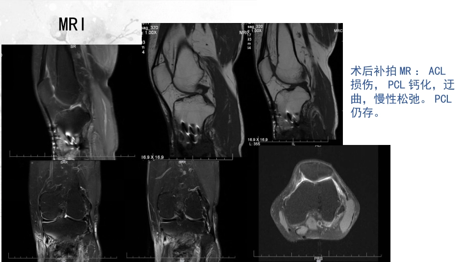 截骨术在不稳定 膝关节的作用_第8页