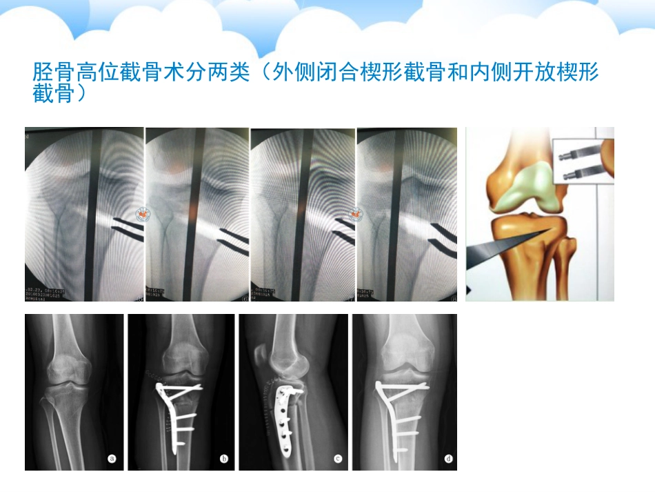 胫骨高位 截骨术_第13页