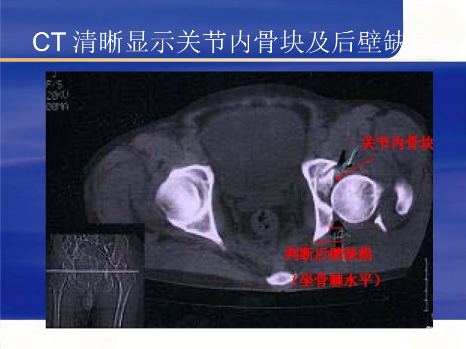 髋臼骨折的 诊断及治疗_第12页