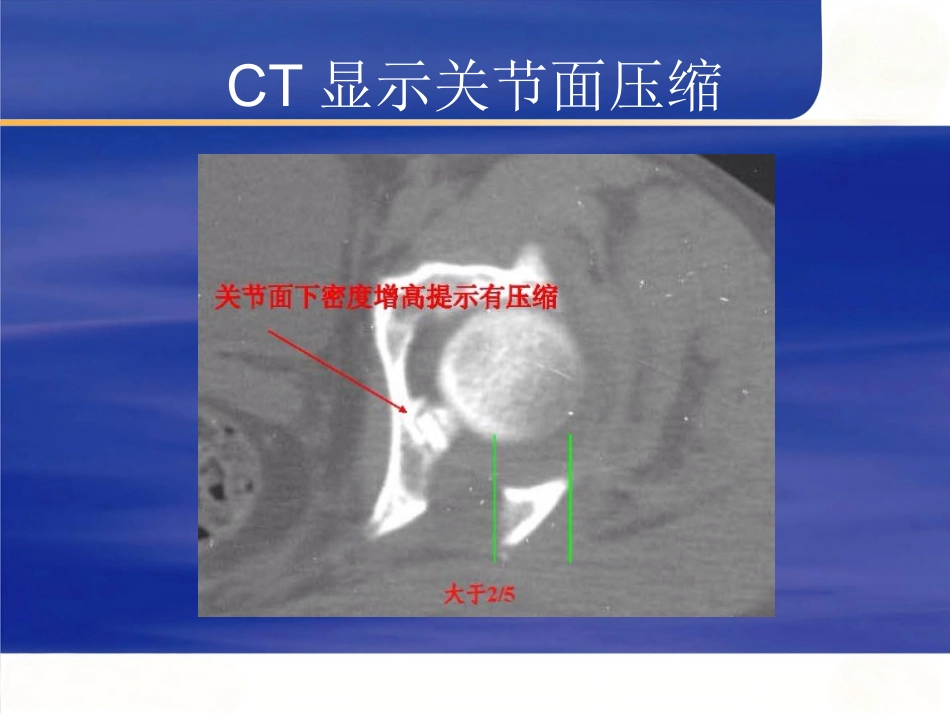 髋臼骨折的 诊断及治疗_第13页