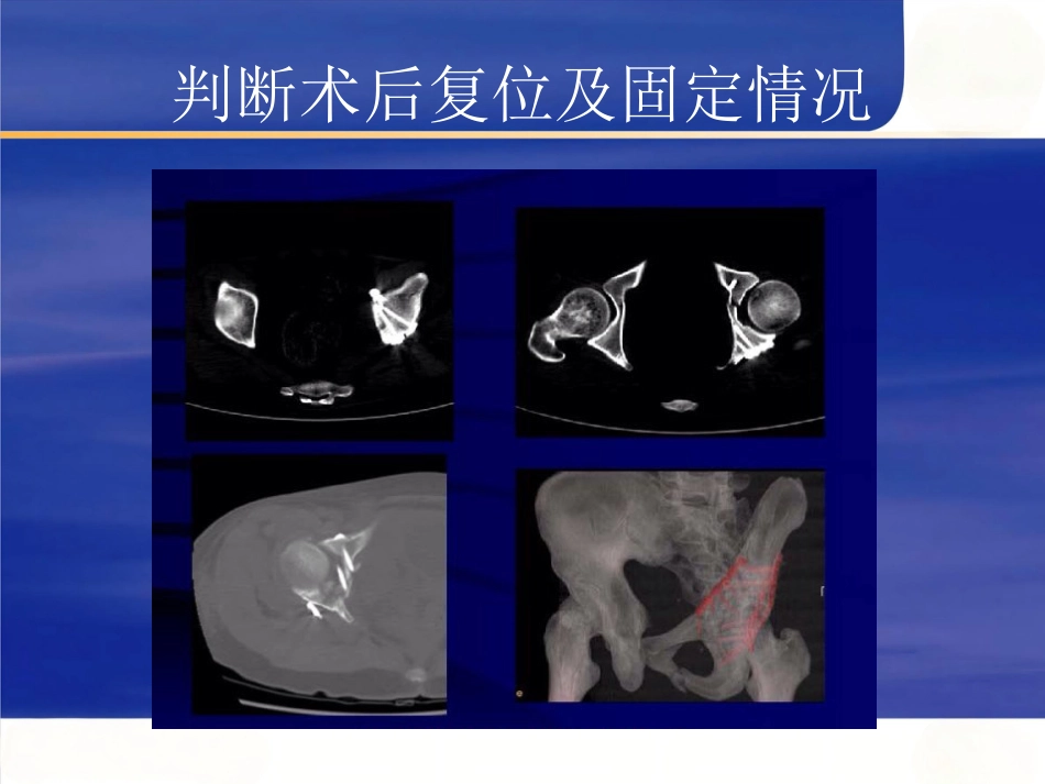 髋臼骨折的 诊断及治疗_第14页