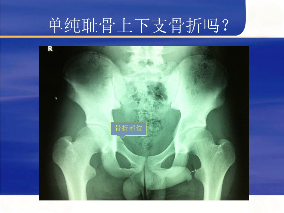 髋臼骨折的 诊断及治疗_第15页