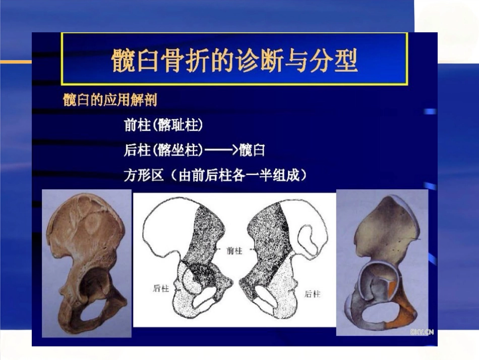 髋臼骨折的 诊断及治疗_第2页