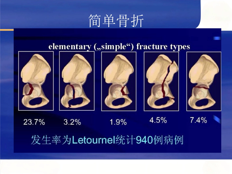 髋臼骨折的 诊断及治疗_第4页