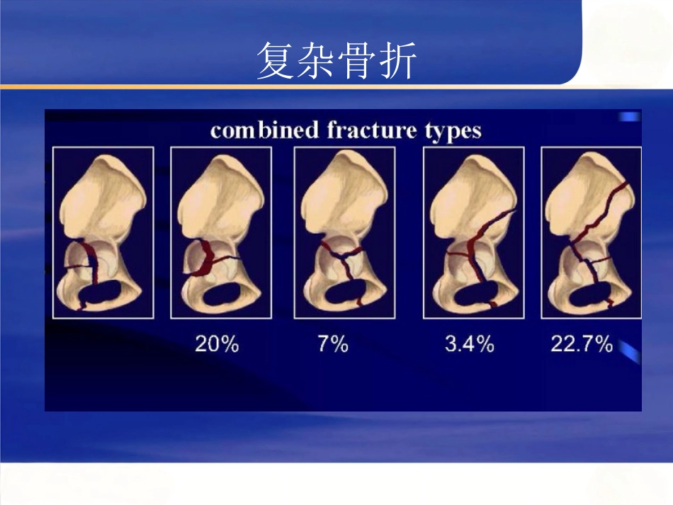 髋臼骨折的 诊断及治疗_第5页