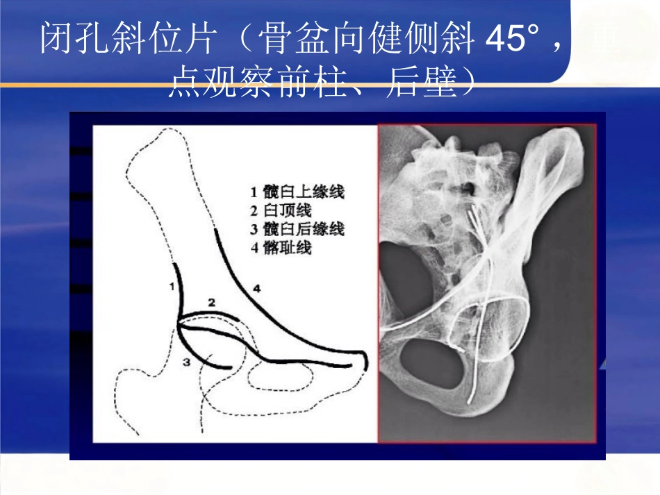 髋臼骨折的 诊断及治疗_第7页
