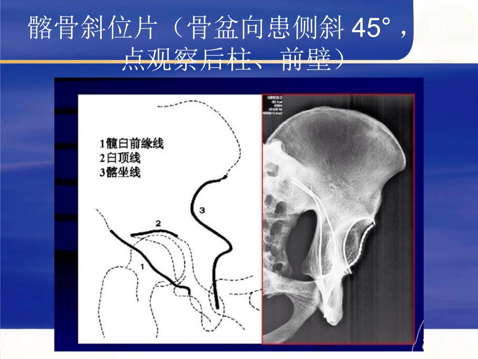 髋臼骨折的 诊断及治疗_第8页