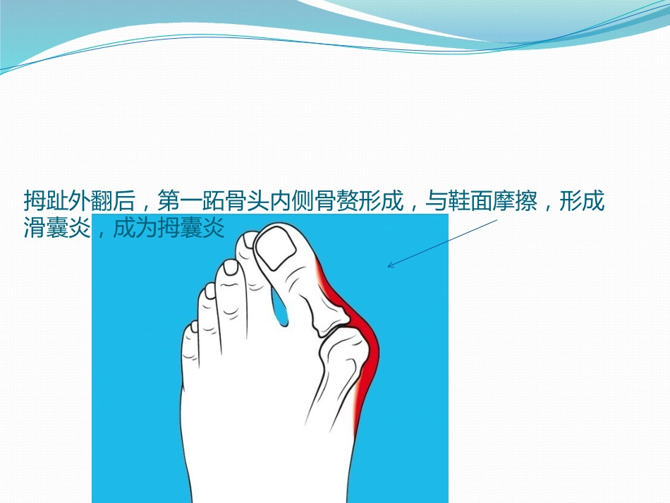 拇外翻 的诊断治疗PPT课件_第5页