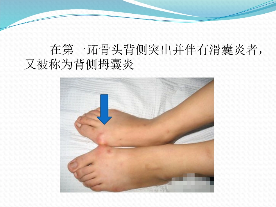 拇外翻 的诊断治疗PPT课件_第6页