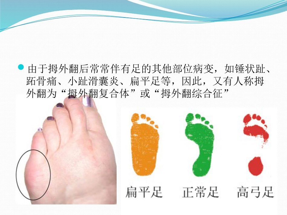 拇外翻 的诊断治疗PPT课件_第7页