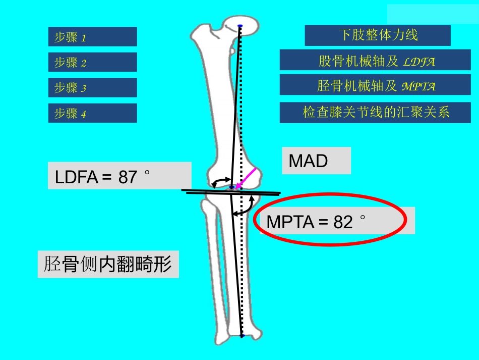 截骨术前 设计_第11页