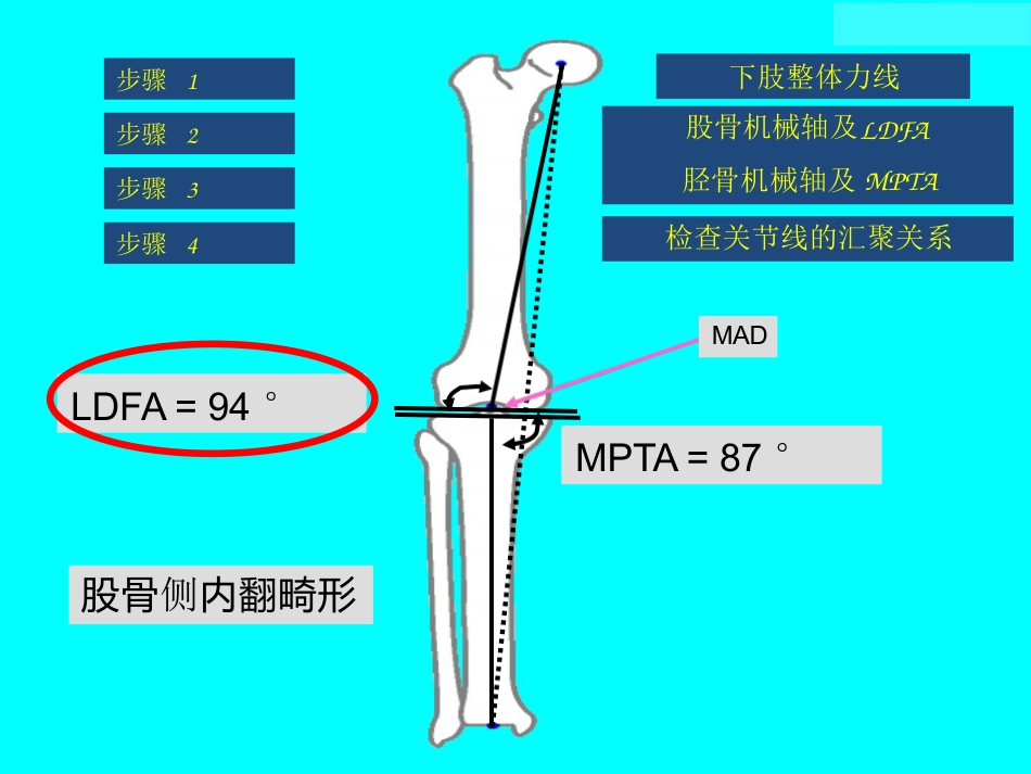 截骨术前 设计_第12页