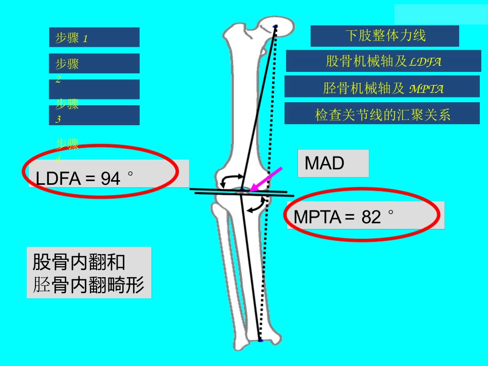 截骨术前 设计_第14页