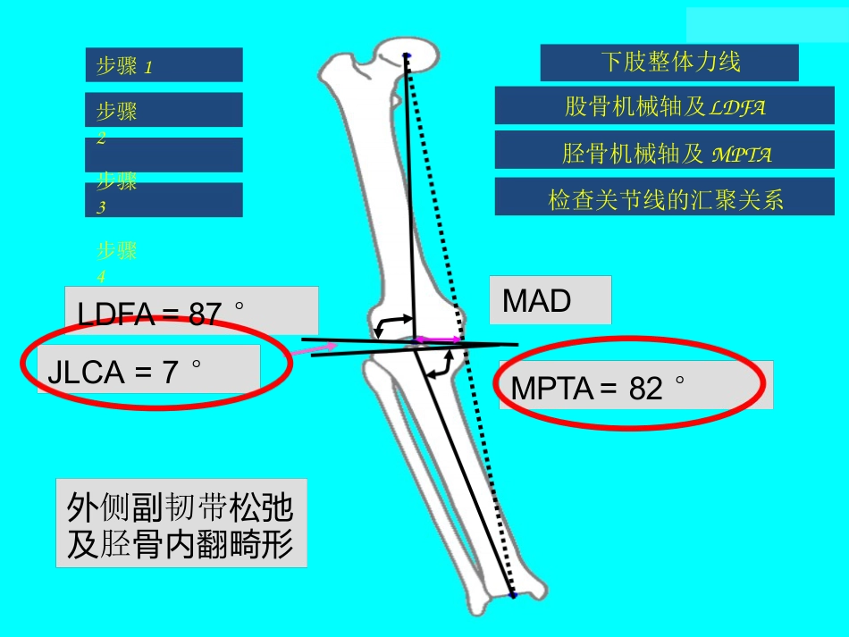 截骨术前 设计_第15页