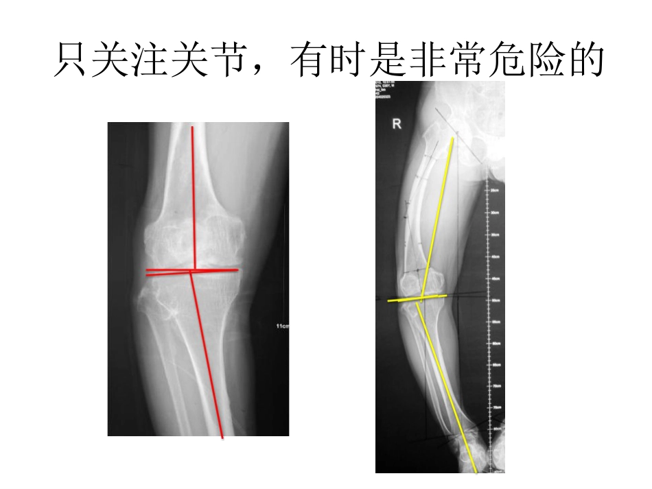 截骨术前 设计_第3页
